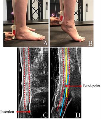 Effective Mechanical Advantage About the Ankle Joint and the Effect of Achilles Tendon Curvature During Toe-Walking